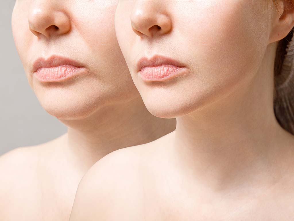 How Can Cheek Augmentation Improve the Contours of Your Face?